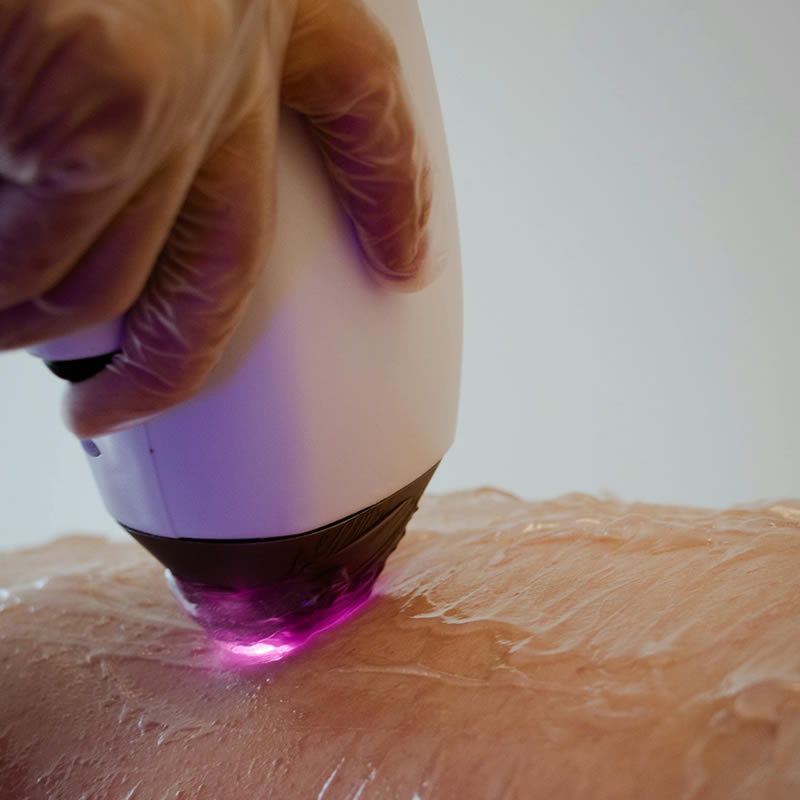 Trajno uklanjanje dlaka: 2 JM Beauty Kaštel Sućurac Split